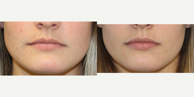 18-24 year old woman treated with Restylane - 22 year old treated with Restylane in her lips to subtley enhance the volume while keeping the natural shape.