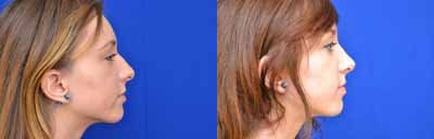Woman treated with Rhinoplasty - Woman treated with Rhinoplasty for improvement of tip and hump
