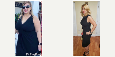 35-44 year old woman treated with Gastric Bypass - Mini Gastric Bypass