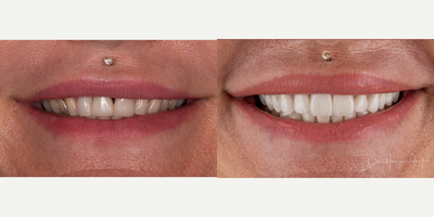 35-44 year old woman treated with Dental Crown, Porcelain Veneers, Smile Makeover, Dental Implants - A full mouth rehabilitation case with all new hand layered ceramics. This patient over the years lost volume and dimension that was restored by opening the bite.