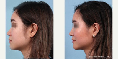 Woman treated with Rhinoplasty, Asian Rhinoplasty - Woman treated with Rhinoplasty, Asian Rhinoplasty