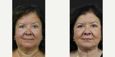 Woman treated with Facial Fat Transfer - Check out these incredible before and after photos from this patient's Deep Plane Face and Neck Lift, Endoscopic Osteoma Removal and Fat Injections by Dr James Marotta just after 6 months!This patient had concerns in her general face and neck area and wanted to look and feel her best at her daughter's upcoming wedding.At the consultation, Dr. Marotta heard her concerns and after evaluation, determined she had an aging appearance, sagging jowls and marionette lines. Her neck concerns consisted of excess fat and turkey neck. Dr James Marotta determined she was a good candidate for a Deep Plane Facelift with Fat Injections and an Endoscopic Osteoma Removal.