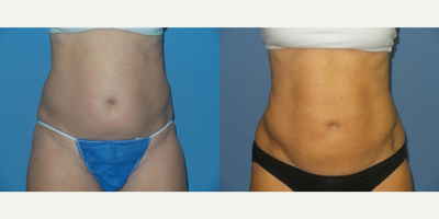 45-54 year old woman treated with BodyTite - 54 y/o female shown 2 months after BodyTite liposuction to her abdomen and flanks.
