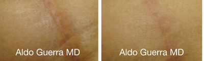 35-44 year old woman treated with Embrace Scar Therapy - Before and after embrace Active Scar Defense treatments for the vertical breast lift incision. Results shown at 4 months.