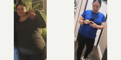 Woman treated with Gastric Sleeve Surgery - The surgery was a complete success, in 20 weeks, the Patient had lost 70 pounds.