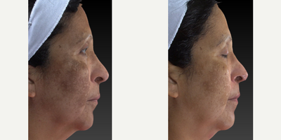 55-64 year old woman treated with Laser Treatment - This woman has relatively bad melasma. With some fractionated radio-frequency and topical medications after one treatment she is very happy. She is able to conceal the issue and is very happy. The best is yet to come! Our melasma protocol includes 4 treatments and a maintenance package.