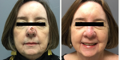 65-74 year old woman treated with Mohs Closure Surgery - This patient benefitted from Moh's Closure Surgery with Flap Reconstruction. She is delighted with her results!