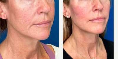 45-54 year old woman treated with Endolift, Nonsurgical Facelift, Nonsurgical Neck Lift, Skin Rejuvenation, Skin Tightening - Endolift Laser is FDA cleared for stimulation of your skin collagen which improves tone, quality and smoothness. Unwanted fat along the jowls, chin and cheek bugles can be contoured. The procedure is outpatient with minimal discomfort or down-time.