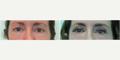 45-54 year old woman treated with Fractional CO2 Laser and Upper Blepharoplasty - This female client presented with the desire for rejuvenation of her eyes.  She wished to reduce the wrinkles under her eyes along with decreasing the amount of skin sitting above her eyelids.  Examination revealed moderate excessive hooding above the eyes along with moderate/severe wrinkles under her eyes.  We decided to perform an upper blepharoplasty (to remove the excess skin) and fractionated CO2 laser to the lower eye skin.  Both procedures were performed on the same day (under one hour) only using local anesthesia and mild oral sedation with valium.  Her results demonstrate natural appearing increased show of her upper eyelids along with significant decrease in her lower eye wrinkles.  She was able to return to work and the gym after one week recovery.