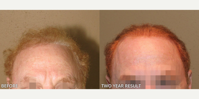 Man treated with Hair Transplant, FUE Hair Transplant - Man treated with Hair Transplant, FUE Hair Transplant