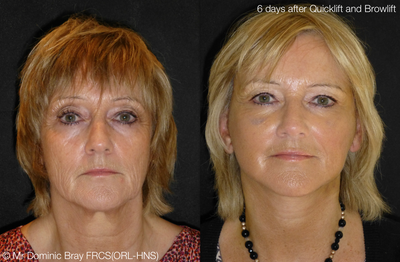 62 year old lady for Quicklift - 
	This photo is taken only 6 days after Quicklift face and neck lift and Browlift. Performed under local anaesthetic alone.&nbsp;
