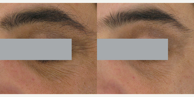 SkinCeuticals, AOX Eye Gel - AOX Eye Gel. Product applied once daily in the morning. For controlled results, subjects used with SkinCeuticals Gentle Cleanser and a SkinCeuticals sunscreen daily.  Photo provided courtesy of SkinCeuticals.
