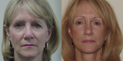 55-64 year old woman treated with Brow Lift - 56-year-old woman treated with Facelift, Browlift, 4-Lid Blepharoplasty and vermillion lip advancement.