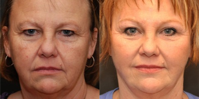 Woman treated with Brow Lift - Brow Lift
