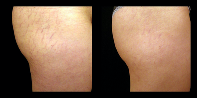 25-34 year old woman treated with Affirm Laser - 25-34 year old woman treated with Affirm Laser to reduce the appearance of stretch marks.