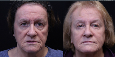 75 and up year old woman Nonsurgical Facelift - Combination of fillers, PRP and toxins were used to improve the hollow and enhance the facial features.
