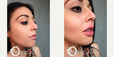 25-34 year old woman treated with Lip Augmentation - Lip augmentation