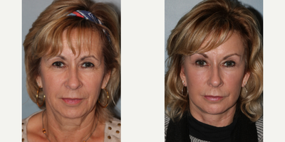64 year old woman treated with Lifestyle Lift - This patient had a LiteLift, Chin augmentation, Temple lift, Blue Peel, and neck lift were performed simultaneouslyon an out patient basis under general anesthesia.After photos were taken 7 months post-op.