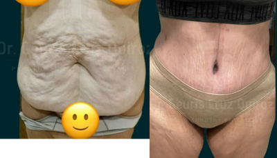 45-54 year old woman treated with Liposculpture - This lovely patient came to my office looking for a better look in her 50's after loosing weight she was looking for a fresh look, after her physical evaluation we decide to do Tummy tuck with muscle repair, 360 lipo and BBL.