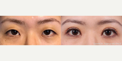 Woman treated with Eyelid Surgery - Woman treated with Eyelid Surgery