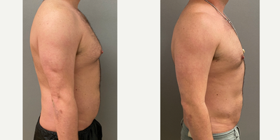 35-44 year old man treated with Liposuction, SAFELipo, Tumescent Liposuction - 39 yo s/p abdominal liposuction performed under sedation in our on site AAAA certified operating suite