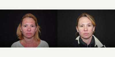 35-44 year old woman treated with IPL - 42 year old female received Cynosure; photos depict the patients results 1 month post-op from her 3rd treatment.