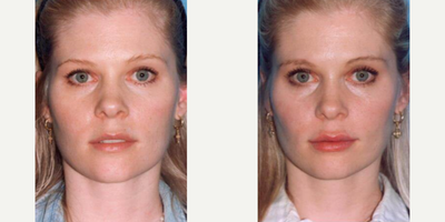 Woman treated with Dermal Fillers - Woman treated with Dermal Fillers using hyaluronic-acid filler for a fuller lips.