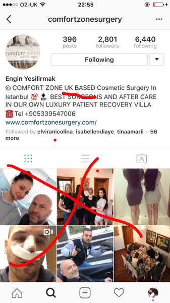 Warning Botched By Comfortzone Surgery Istanbul Engin