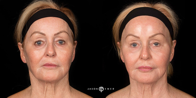 55-64 year old woman treated with Cosmelan - This is a 60-65 year old woman who received Cosmelan and facial fillers one month post procedure.