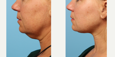 45-54 year old woman following correction of her turkey neck with liposuction and Renuvion Powered by J-Plasma dermal tightening - Renuvion Powered by J-Plasma&trade; is a revolutionary minimally invasive procedure that uses cold helium plasma energy on the underside of the skin to instantly tighten and rejuvenate anywhere on the face and body. A unique alternative to traditional facelifts, tummy tucks and body sculpting, the J-Plazty&trade; procedure will shrink and sculpt loose and lax skin without large incisions, downtime or the complications of cosmetic surgery.