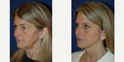 45-54 year old woman treated with Facelift - Lateral SMASectomy facelift with platysmaplasty and upper and lower blepharoplasty.