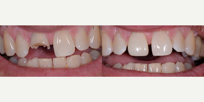 45-54 year old man treated with Tooth Repair - This gentleman broke his tooth while eating--we had him back in great shape in less than an hour.