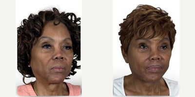 65-74 year old woman treated with Lip Lift, Lip Surgery, Lip Repositioning - Lip lift performed in combination with deep plane facelift and neck lift surgery to restore facial harmony and create elegant, natural rejuvenation. Notice the improvement in facial balance, horizontal thirds, upper tooth show, and the meticulously concealed lip lift scar. Smiling views also demonstrate preservation of natural facial expression and harmony following facial rejuvenation surgery.