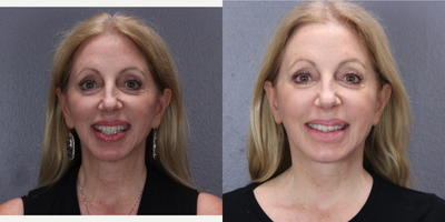 55-64 year old woman treated with Cheek Implant - 58-year-old desired more full cheeks, so implants were inserted.