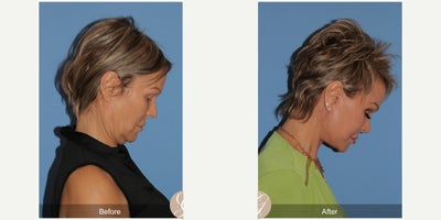 59 year old woman treated with Deep Plane Facelift, Facelift, Neck Lift, TCA Peel - 59 year old woman treated with Deep Plane Face and Neck Lift, TCA Peel