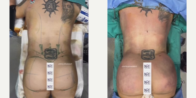25-34 year old woman treated with Mommy Makeover, Tummy Tuck, Vaser Liposuction, Brazilian Butt Lift - 25-34-year-old woman treated with Mommy Makeover, No Drain Tummy Tuck, Vaser Lipo 360, Safer BBL1 day post-op