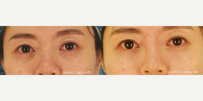 18-24 year old female treated with Volbella - Patient complained of her deep tear troughs and overall tired appearance. 1 syringe of Volbella was injected to bilateral tear troughs with good effect. (Radiesse was also used to augment her radix)