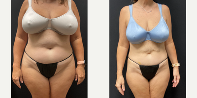 Woman treated with Semaglutide - Woman treated with Semaglutide