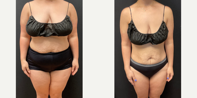 Woman treated with Semaglutide - Woman treated with Semaglutide