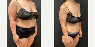 Woman treated with Semaglutide - Woman treated with Semaglutide
