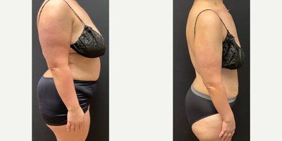 Woman treated with Semaglutide - Woman treated with Semaglutide