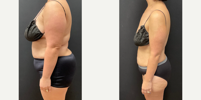 Woman treated with Semaglutide - Woman treated with Semaglutide