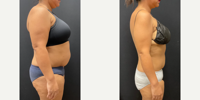 Woman treated with Semaglutide - Woman treated with Semaglutide