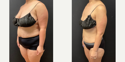 Woman treated with Semaglutide - Woman treated with Semaglutide