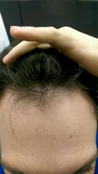 Hair Transplant Dr Koray Erdogan Istanbul Tr Review Realself