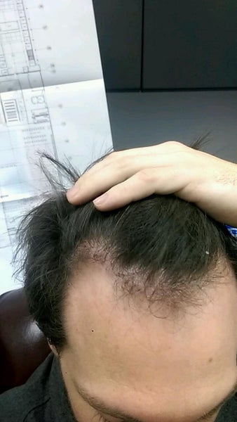 Hair Transplant Dr Koray Erdogan Istanbul Tr Review Realself