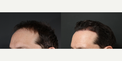 35-44 year old man treated with Hair Transplant - FUT 3250 before and afters