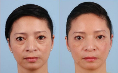 Woman treated with Restylane - Woman treated with Restylane onher cheeks and tear troughs