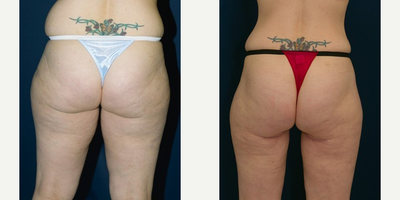 Woman treated with Thigh Lift - Woman treated with Thigh Lift