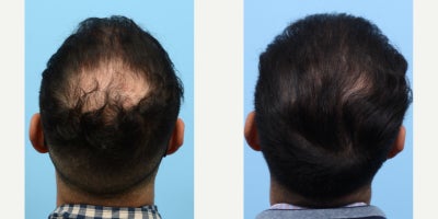 35-44 year old man treated with FUE Hair Transplant, Hair Transplant, Hair Loss Treatment, PRP for Hair Loss, PRP Injections - This patient wanted to restore hair to zones 1,2 and 4 of his scalp. Dr. Wise performed an FUE hair transplant with one session of PRP therapy to achieve this patient's goal.